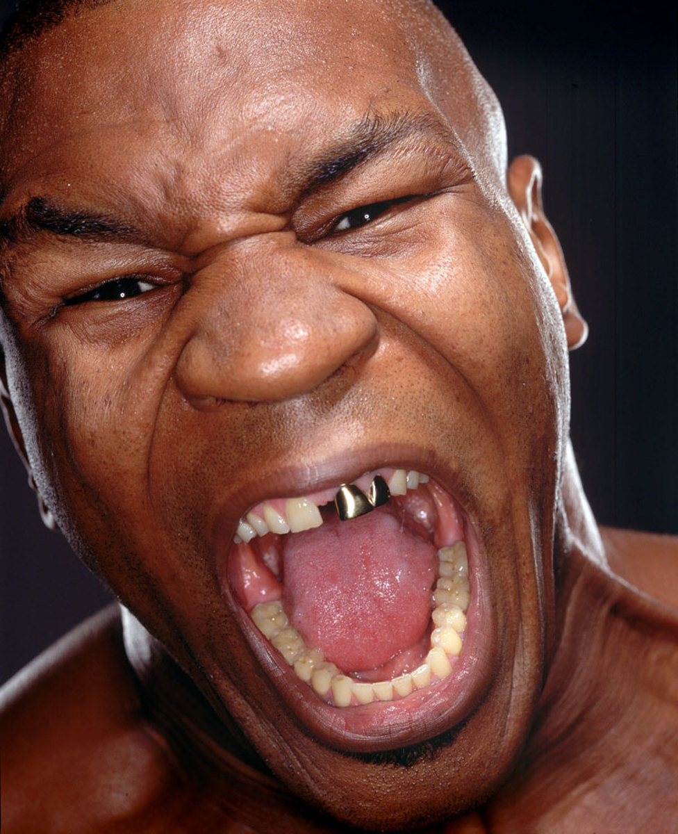 Mike Tyson before dental work